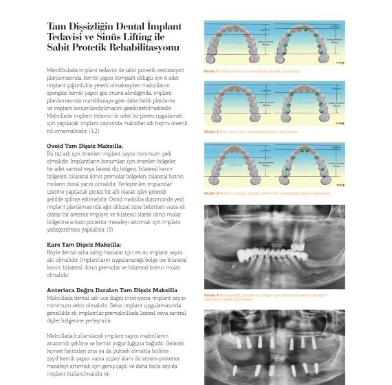 Tam Dişsizliğin Dental İmplant Tedavisi ve Sinüs Lifting İle Sabit Protetik Rehabilitasyonu